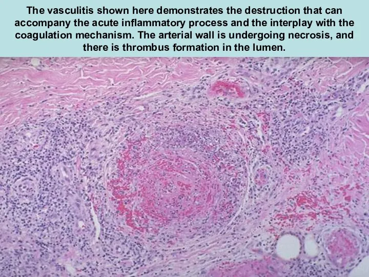 The vasculitis shown here demonstrates the destruction that can accompany the acute inflammatory
