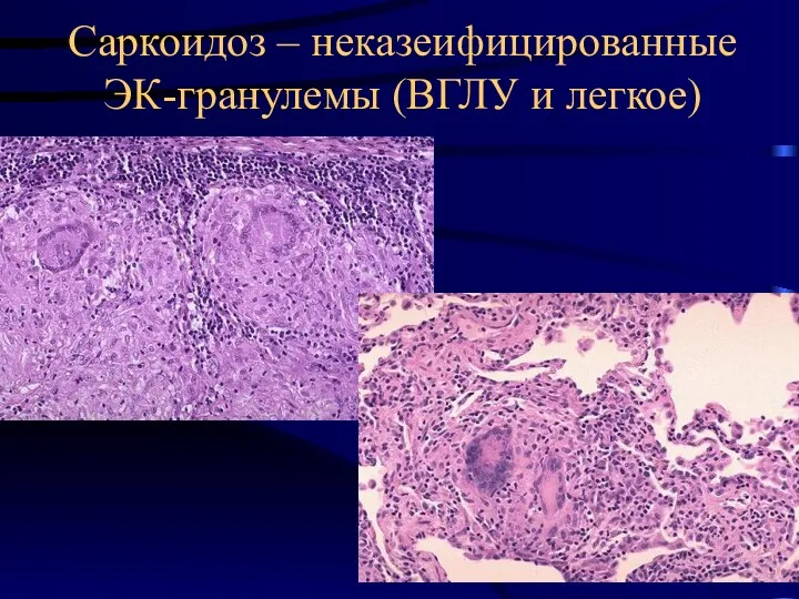 Саркоидоз – неказеифицированные ЭК-гранулемы (ВГЛУ и легкое)