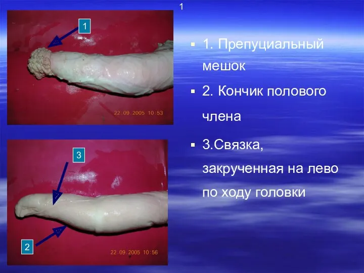 1 1. Препуциальный мешок 2. Кончик полового члена 3.Связка, закрученная