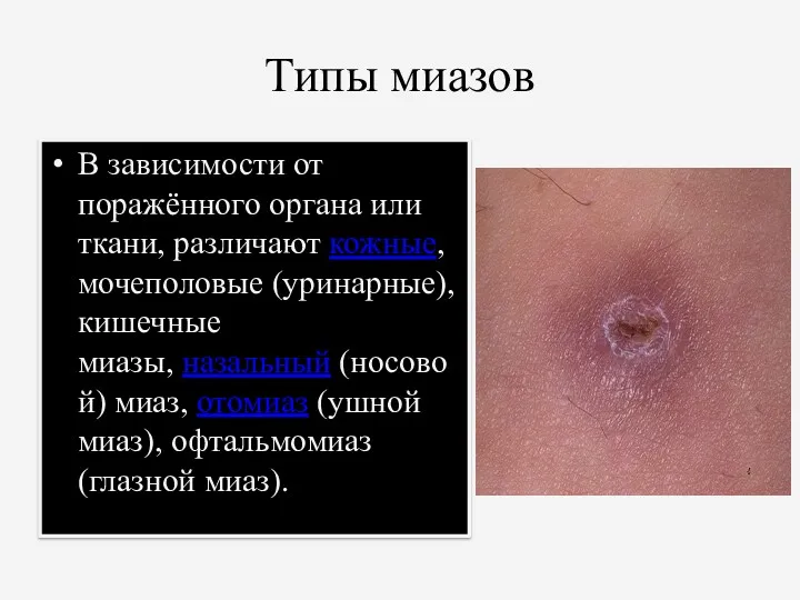 Типы миазов В зависимости от поражённого органа или ткани, различают