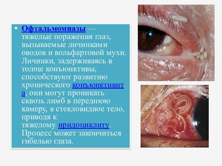 Офтальмомиазы — тяжелые поражения глаз, вызываемые личинками оводов и вольфартовой