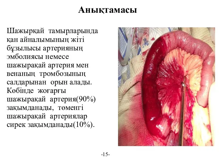 Анықтамасы Шажырқай тамырларында қан айналымының жіті бұзылысы артерияның эмболиясы немесе