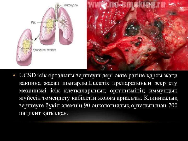 UCSD ісік орталығы зерттеушілері өкпе рагіне қарсы жаңа вакцина жасап шығарды.Lucanix препаратының әсер