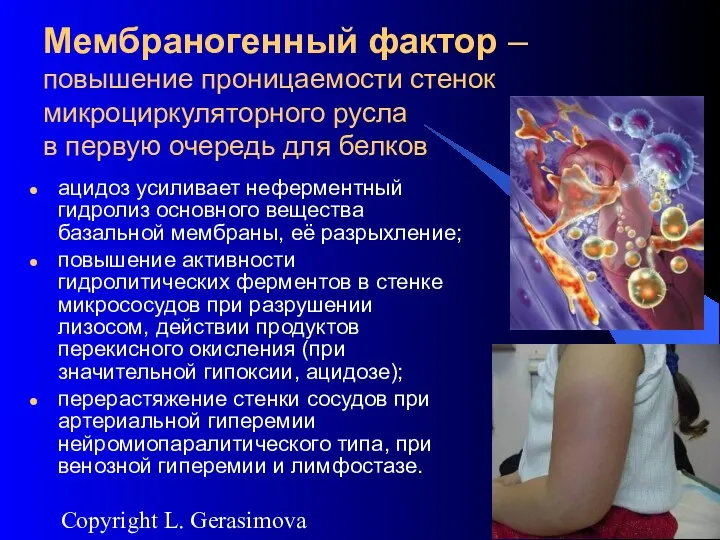 2007 Copyright L. Gerasimova Мембраногенный фактор – повышение проницаемости стенок