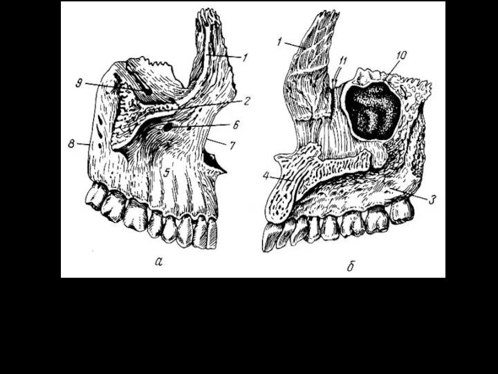 Верхняя челюсть. а - правая кость (вид снаружи); б -