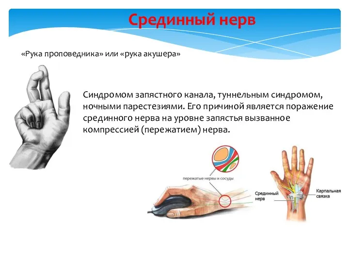 «Рука проповедника» или «рука акушера» Срединный нерв Синдромом запястного канала,