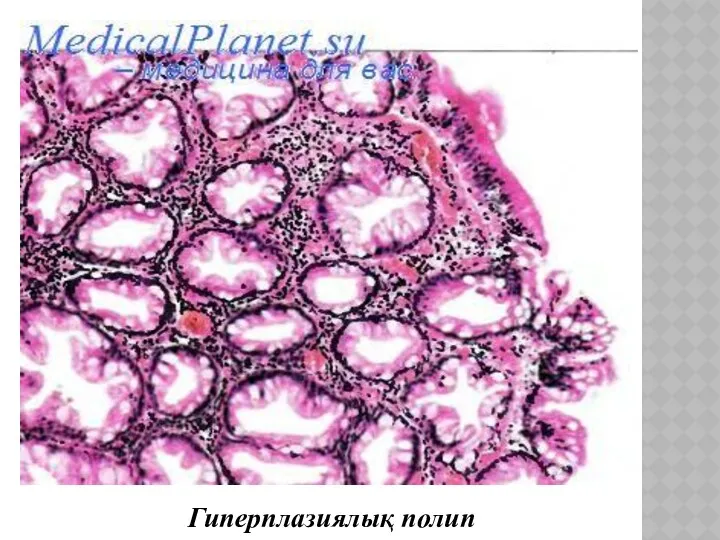 Гиперплазиялық полип