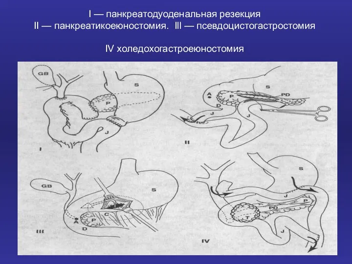 I — панкреатодуоденальная резекция II — панкреатикоеюностомия. Ill — псевдоцистогастростомия IV холедохогастроеюностомия