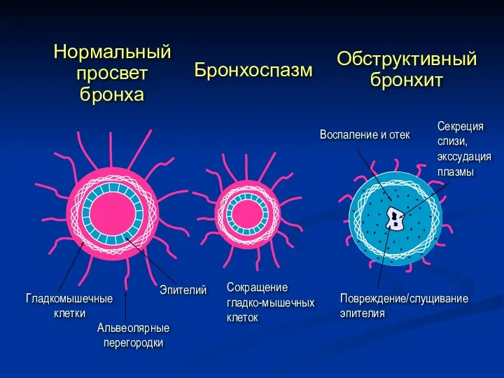 Гладкомышечные клетки Эпителий Альвеолярные перегородки Сокращение гладко-мышечных клеток Повреждение/слущивание эпителия