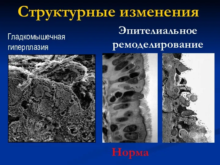 Гладкомышечная гиперплазия Норма Эпителиальное ремоделирование Структурные изменения