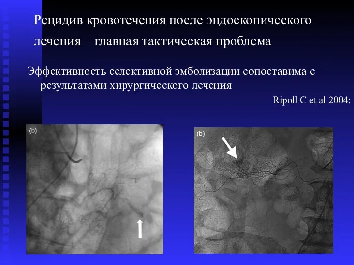 Рецидив кровотечения после эндоскопического лечения – главная тактическая проблема Эффективность селективной эмболизации сопоставима