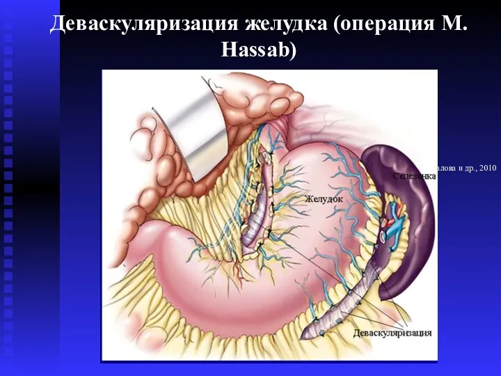 Деваскуляризация желудка (операция М. Hassab) С.Б. Жигалова и др., 2010