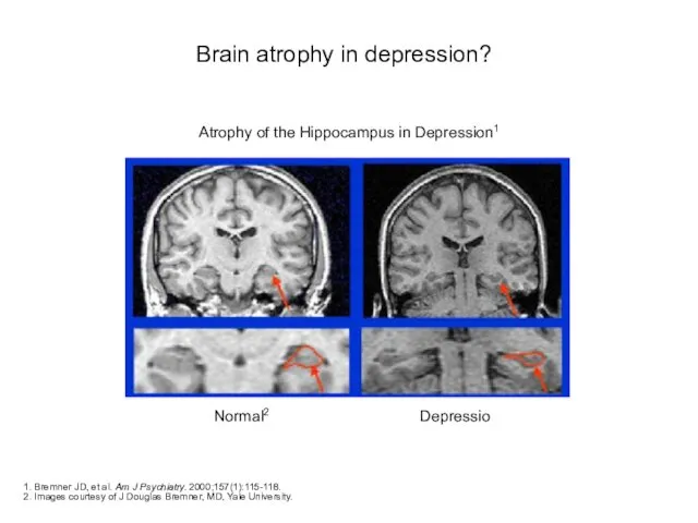 Brain atrophy in depression? 1. Bremner JD, et al. Am