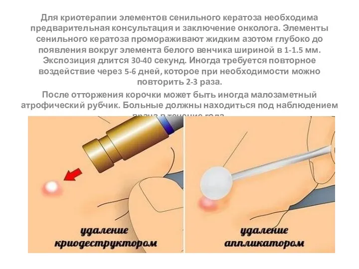 Для криотерапии элементов сенильного кератоза необходима предварительная консультация и заключение