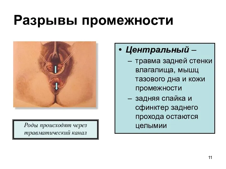 Разрывы промежности Центральный – травма задней стенки влагалища, мышц тазового