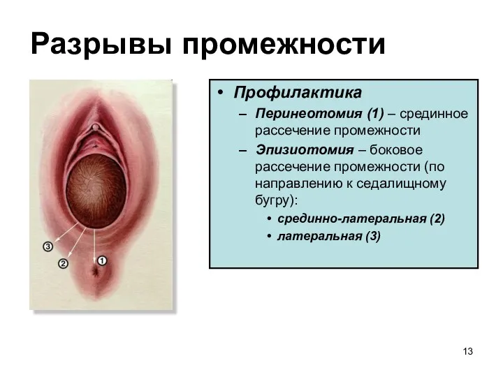 Разрывы промежности Профилактика Перинеотомия (1) – срединное рассечение промежности Эпизиотомия