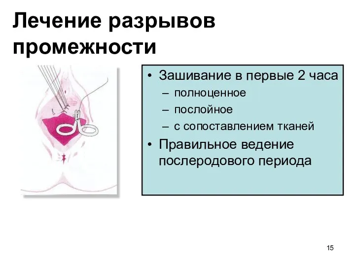 Лечение разрывов промежности Зашивание в первые 2 часа полноценное послойное