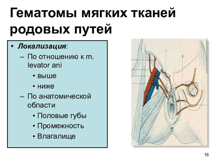 Гематомы мягких тканей родовых путей Локализация: По отношению к m.