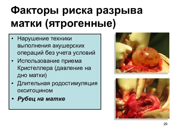 Факторы риска разрыва матки (ятрогенные) Нарушение техники выполнения акушерских операций