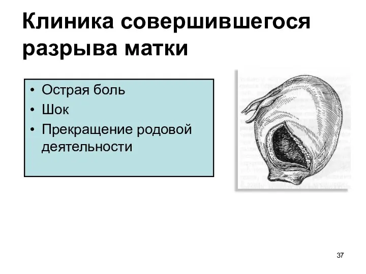 Клиника совершившегося разрыва матки Острая боль Шок Прекращение родовой деятельности