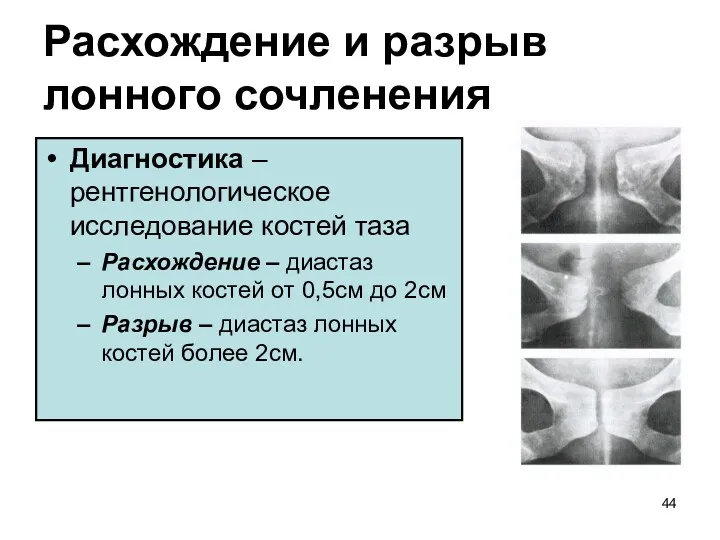 Расхождение и разрыв лонного сочленения Диагностика – рентгенологическое исследование костей