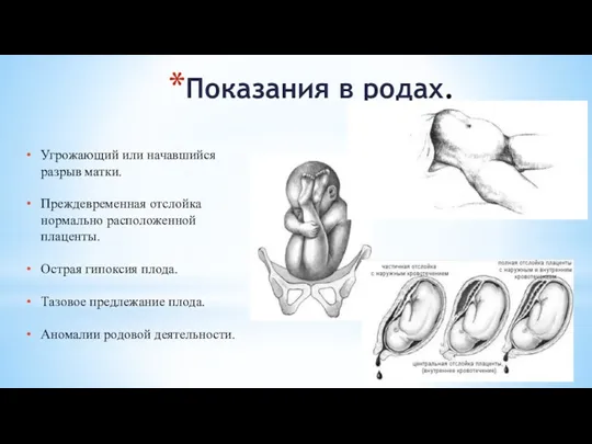 Показания в родах. Угрожающий или начавшийся разрыв матки. Преждевременная отслойка