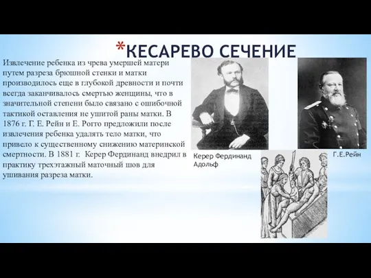 КЕСАРЕВО СЕЧЕНИЕ Извлечение ребенка из чрева умершей матери путем разреза