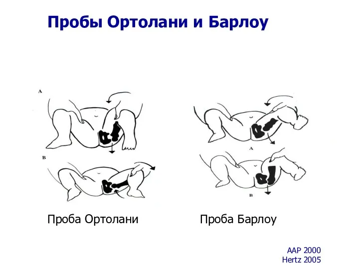 Пробы Ортолани и Барлоу Проба Барлоу Проба Ортолани AAP 2000 Hertz 2005