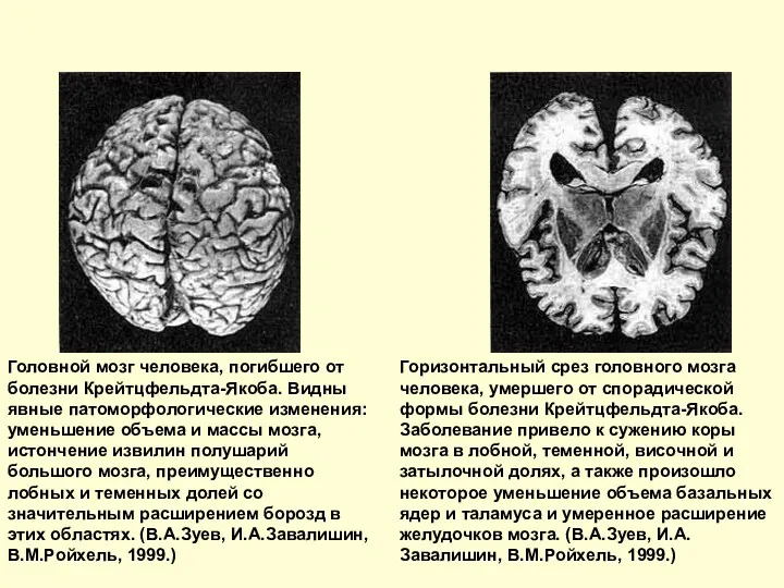 Головной мозг человека, погибшего от болезни Крейтцфельдта-Якоба. Видны явные патоморфологические