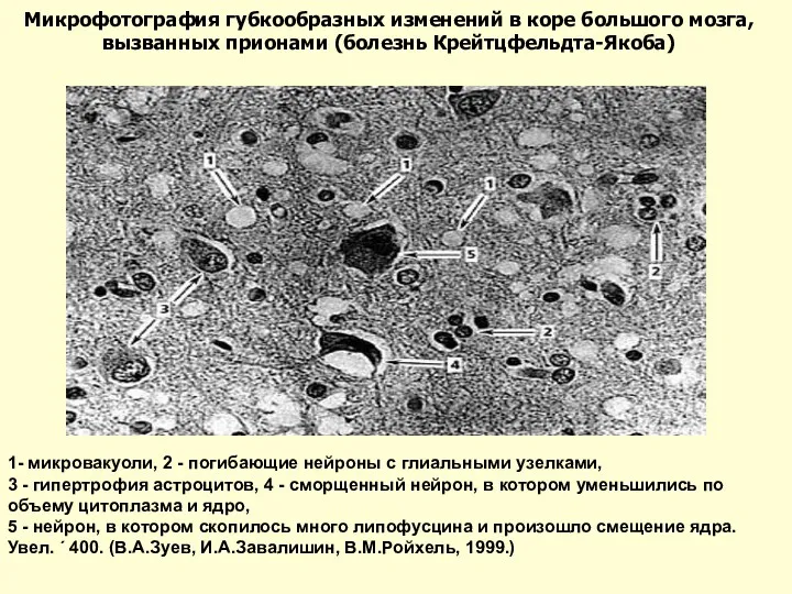 1- микровакуоли, 2 - погибающие нейроны с глиальными узелками, 3