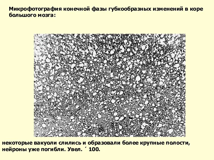 некоторые вакуоли слились и образовали более крупные полости, нейроны уже