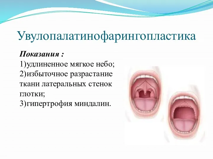 Увулопалатинофарингопластика Показания : 1)удлиненное мягкое небо; 2)избыточное разрастание ткани латеральных стенок глотки; 3)гипертрофия миндалин.