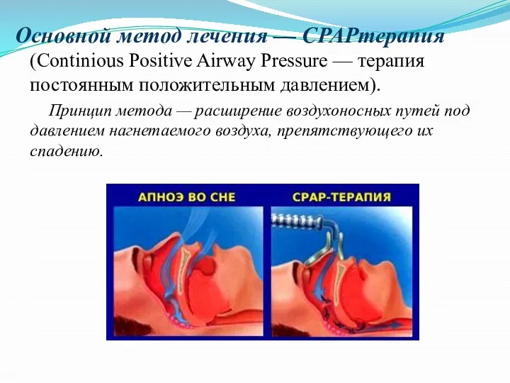 Основной метод лечения — СРАРтерапия (Continious Positive Airway Pressure —