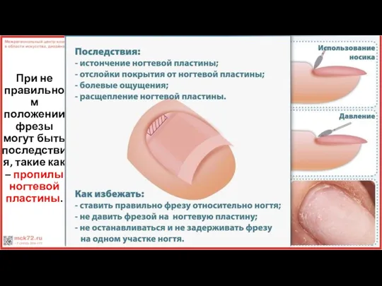 При не правильном положении фрезы могут быть последствия, такие как – пропилы ногтевой пластины.