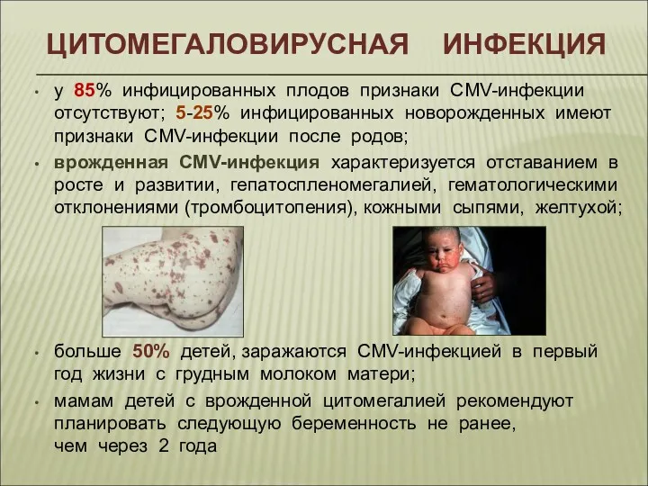 ЦИТОМЕГАЛОВИРУСНАЯ ИНФЕКЦИЯ у 85% инфицированных плодов признаки CMV-инфекции отсутствуют; 5-25%