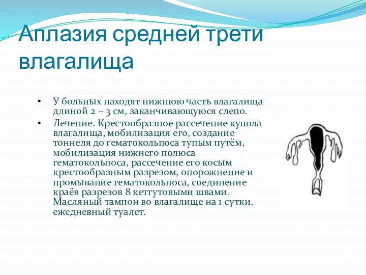 Аплазия средней трети влагалища У больных находят нижнюю часть влагалища длиной 2 –