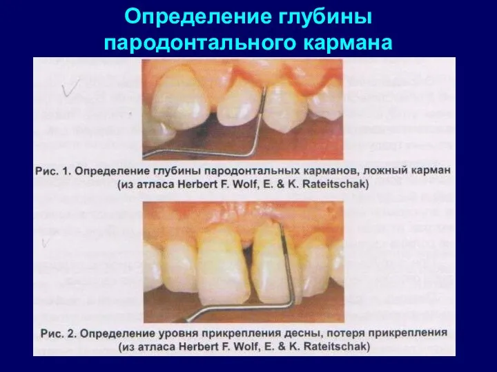 Определение глубины пародонтального кармана