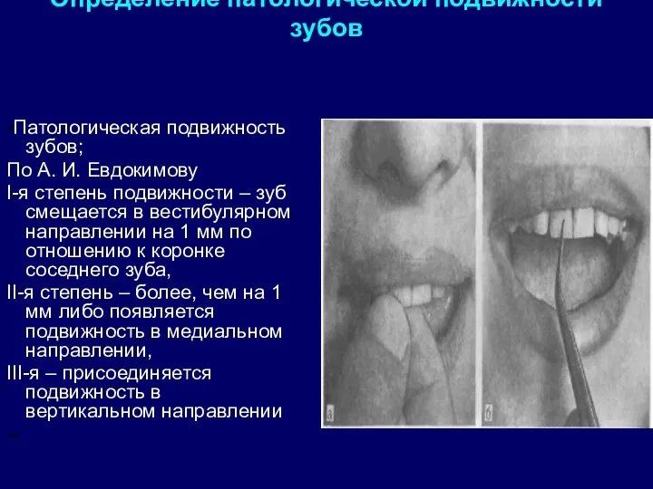 Определение патологической подвижности зубов -Патологическая подвижность зубов; По А. И.