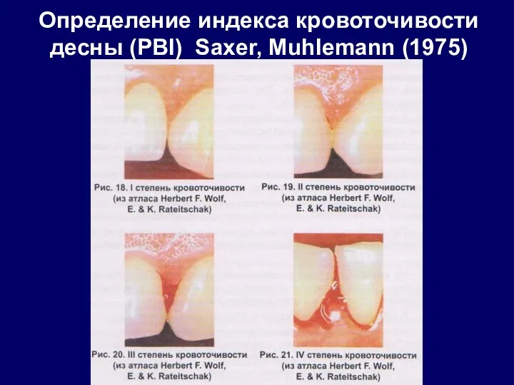 Определение индекса кровоточивости десны (РВI) Saxer, Muhlemann (1975)