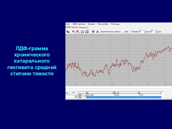 ЛДФ-грамма хронического катарального гингивита средней степени тяжести