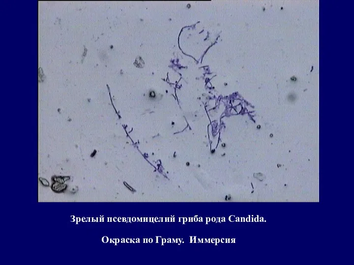 Зрелый псевдомицелий гриба рода Candida. Окраска по Граму. Иммерсия