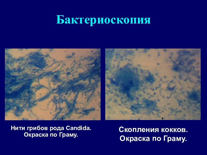 Бактериоскопия Нити грибов рода Candida. Окраска по Граму. Скопления кокков. Окраска по Граму.