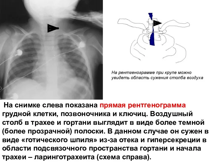 На снимке слева показана прямая рентгенограмма грудной клетки, позвоночника и ключиц. Воздушный столб