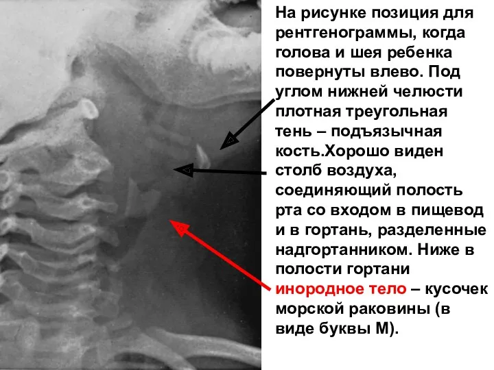 На рисунке позиция для рентгенограммы, когда голова и шея ребенка повернуты влево. Под