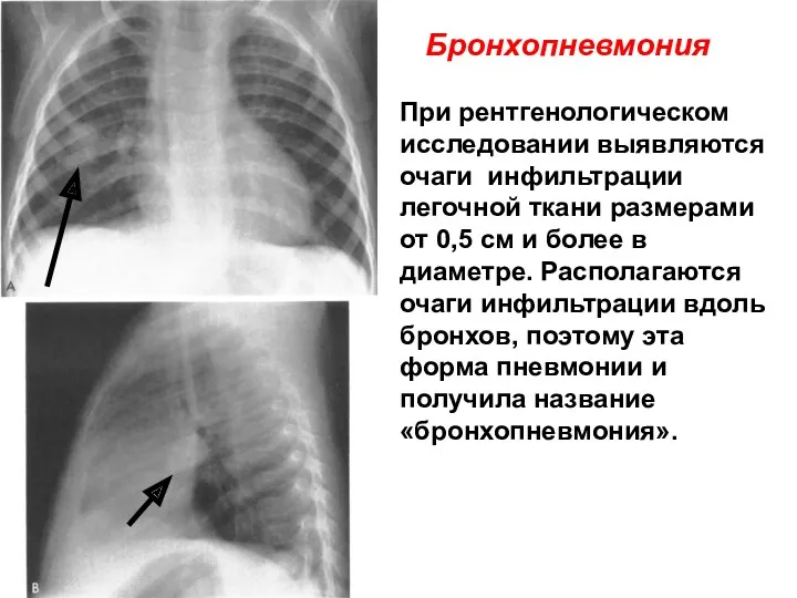 При рентгенологическом исследовании выявляются очаги инфильтрации легочной ткани размерами от 0,5 см и