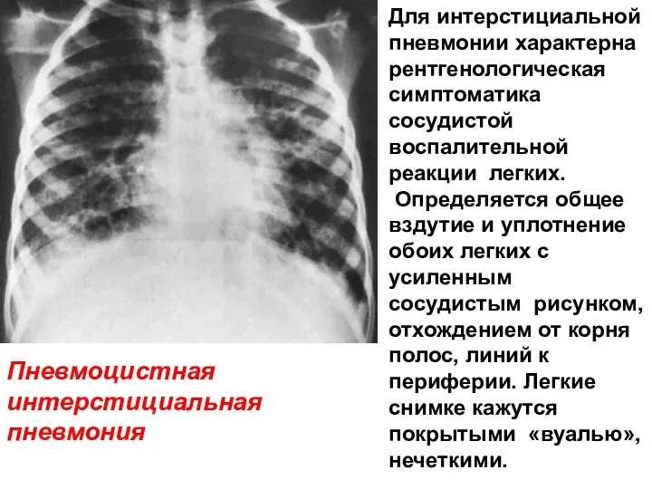 Для интерстициальной пневмонии характерна рентгенологическая симптоматика сосудистой воспалительной реакции легких. Определяется общее вздутие