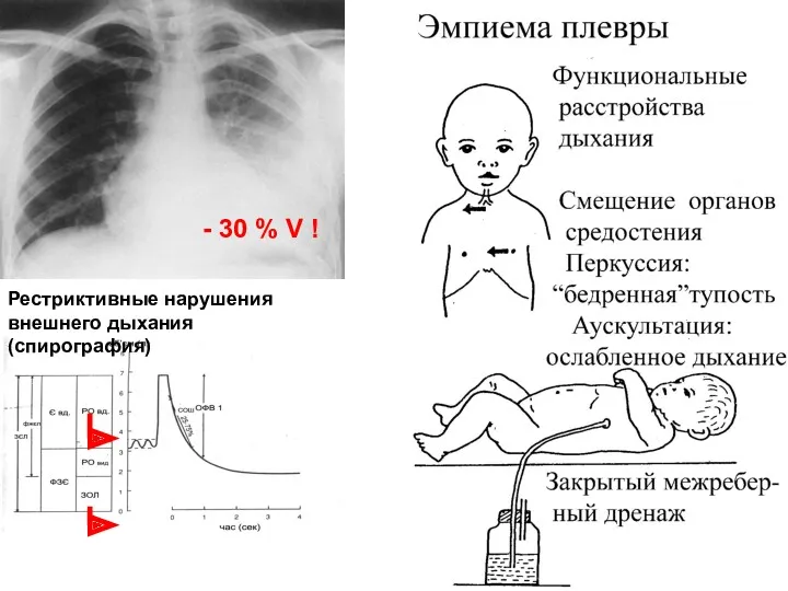 - 30 % V ! Рестриктивные нарушения внешнего дыхания (спирография)
