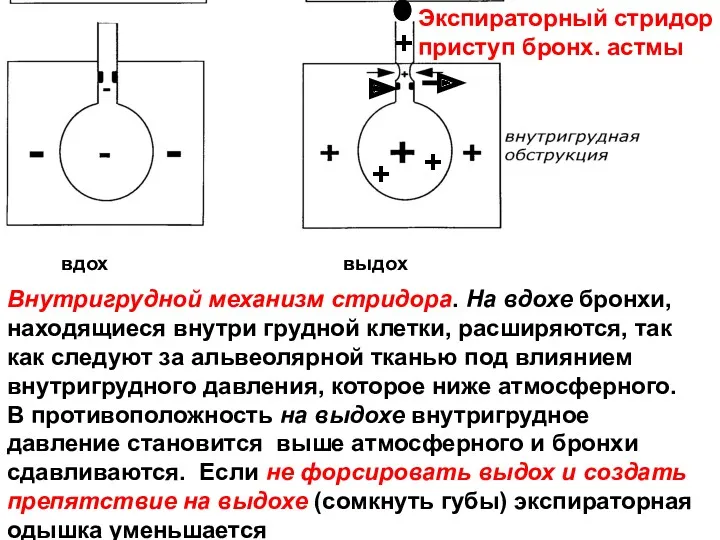 вдох выдох Внутригрудной механизм стридора. На вдохе бронхи, находящиеся внутри