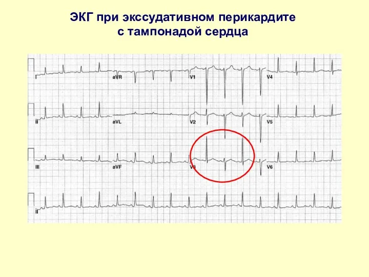 ЭКГ при экссудативном перикардите с тампонадой сердца