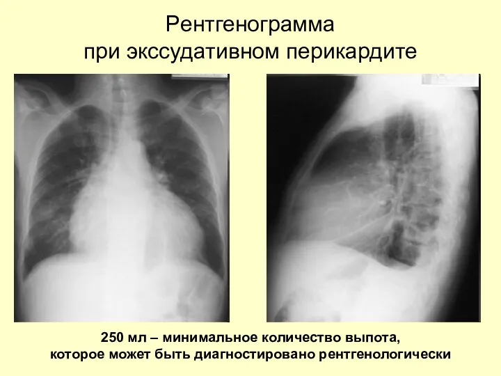 Pентгенограмма при экссудативном перикардите 250 мл – минимальное количество выпота, которое может быть диагностировано рентгенологически